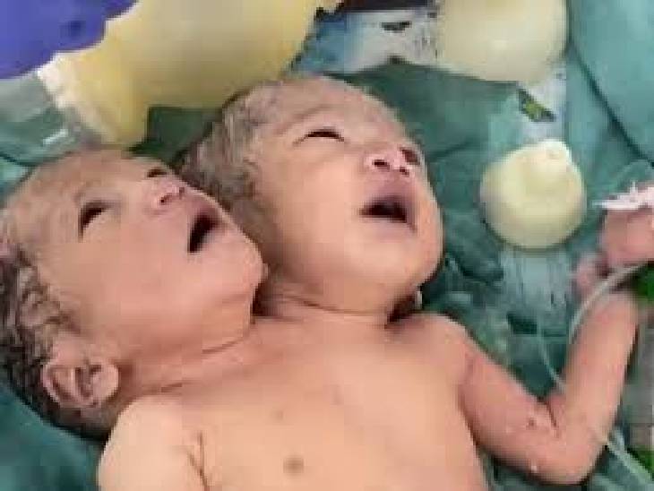 You are currently viewing MP में चौंकाने वाला मामला: इंदौर में फिर जन्मी दुर्लभ नवजात, एक शरीर में दो सिर, दो दिल और चार हाथ; डॉक्टर भी हैरान, PICU में चल रहा इलाज!